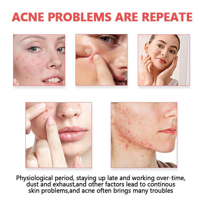 Adesivos Invisíveis para Acne, - Skincare Oil Control avaliação e preço